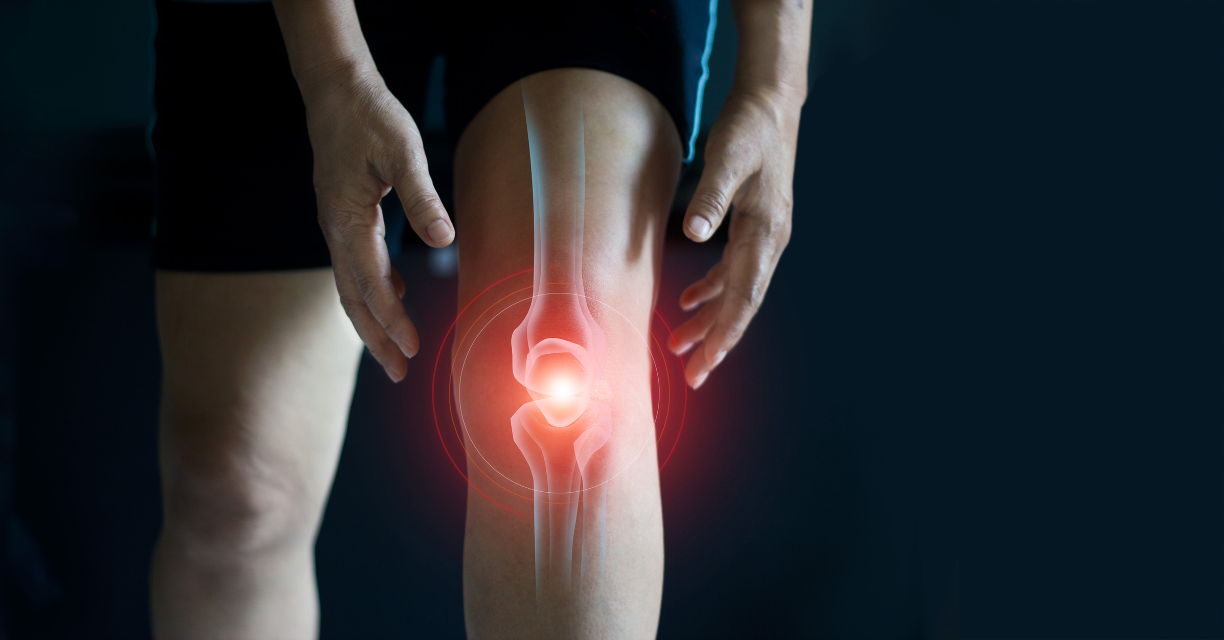 Chondroitin Sulfate (CS) for the Management of Symptomatic Knee Osteoarthritis