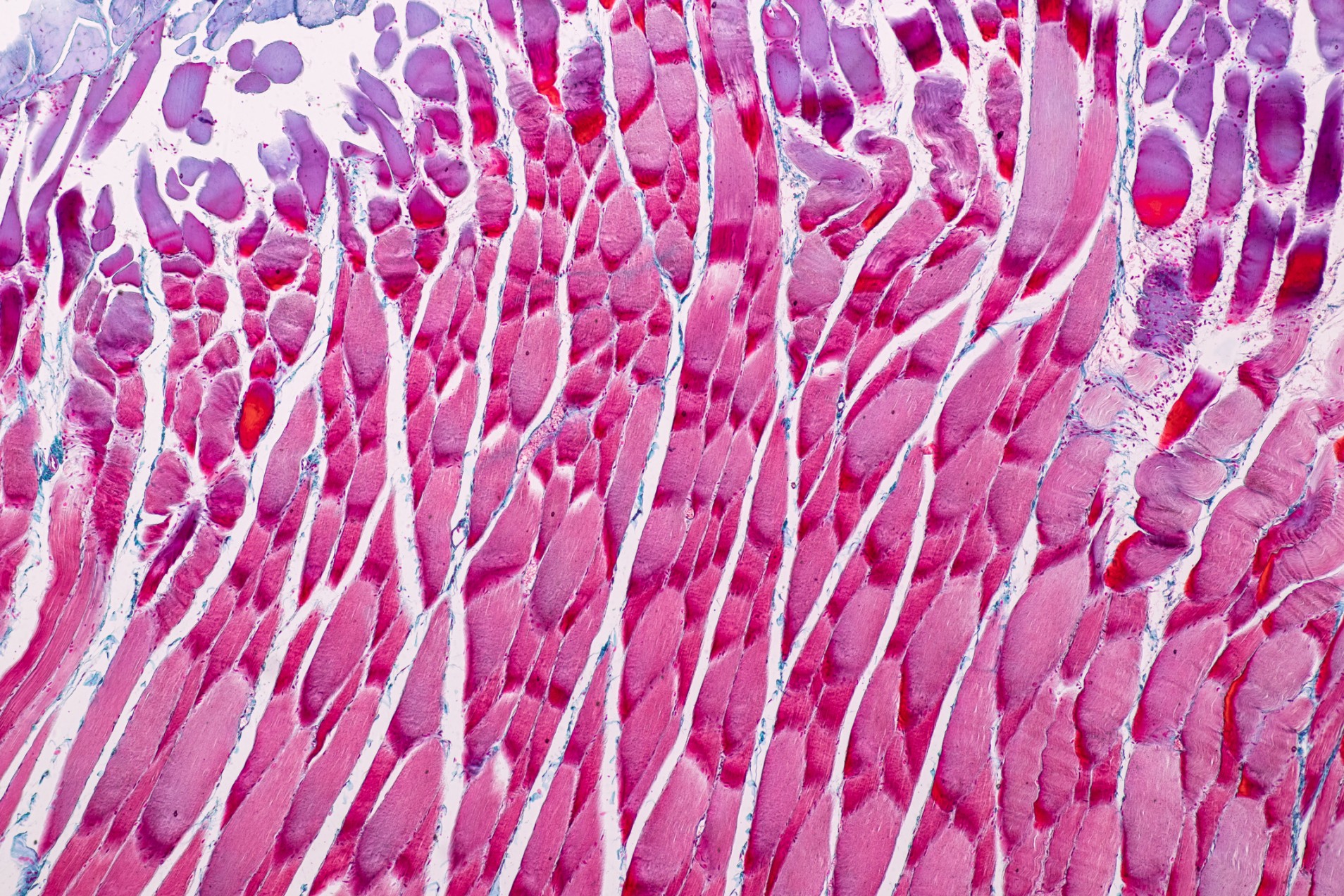 Low Muscle Insulin Sensitivity in Poorly Controlled T2D is Associated with Incomplete Skeletal Muscle Fatty Acid
