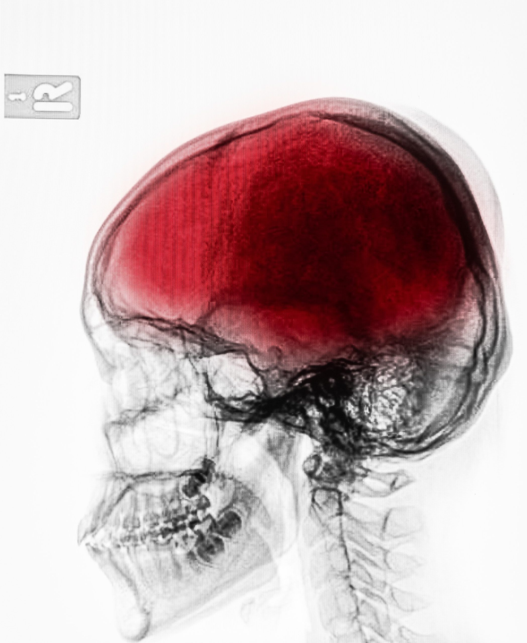 Gut Molecules Control Brain Inflammation