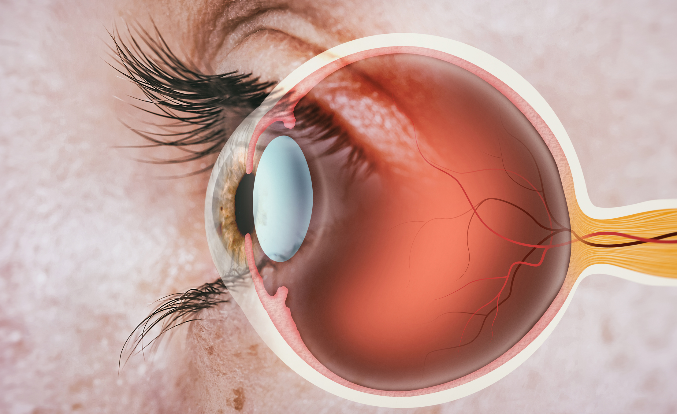 T2D Remission & Retinopathy