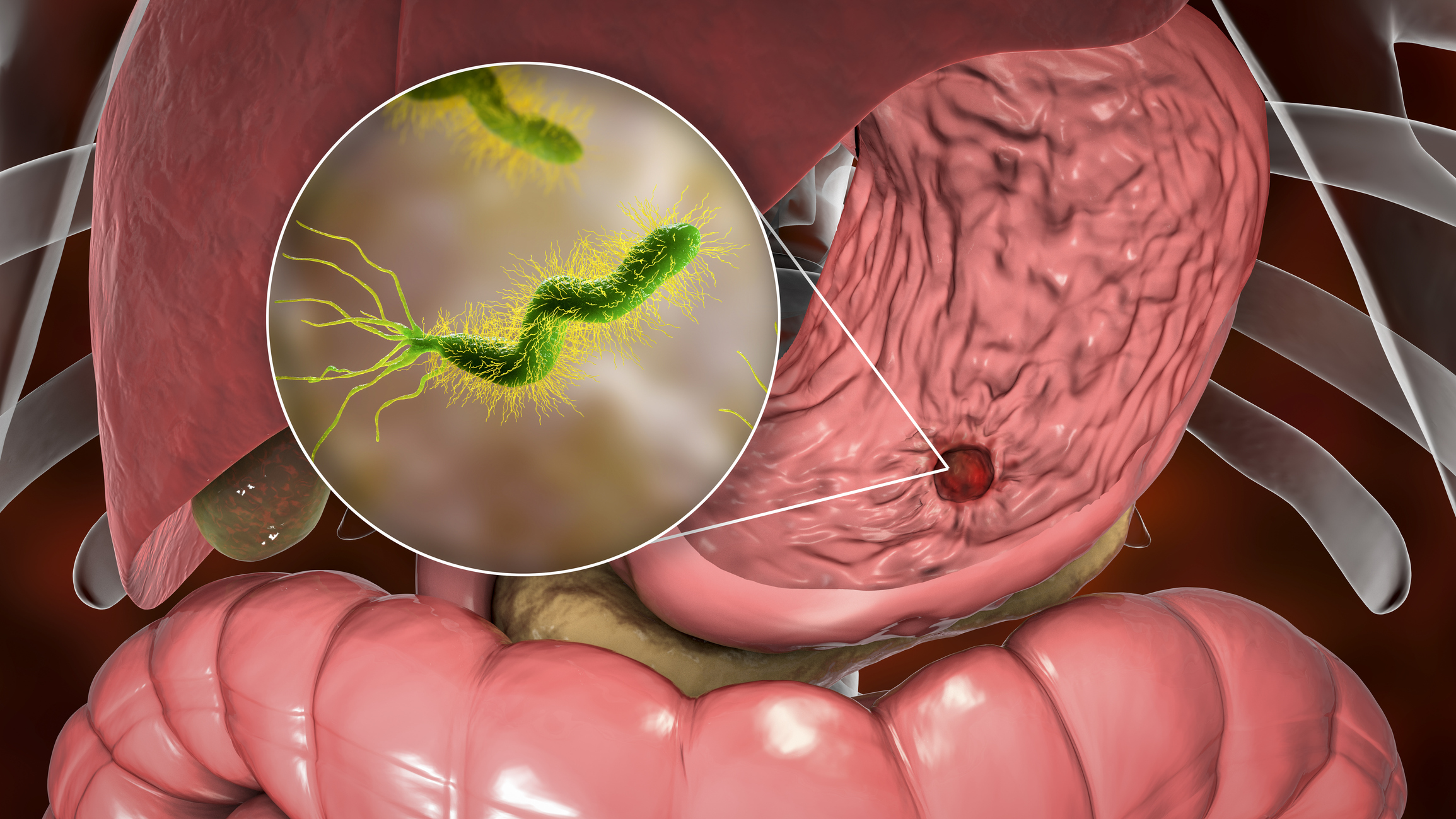 Vitamin B6 & H. pylori