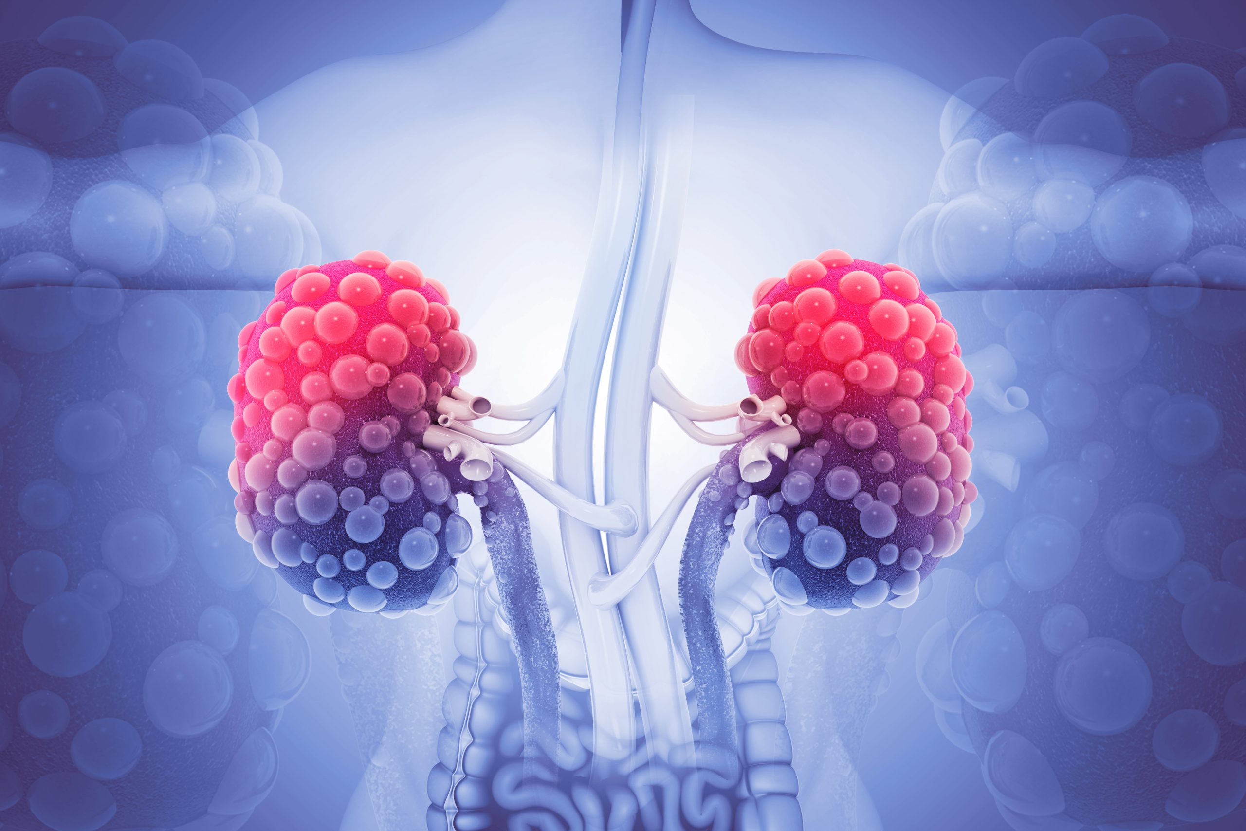 Keto & Polycystic Kidney Disease